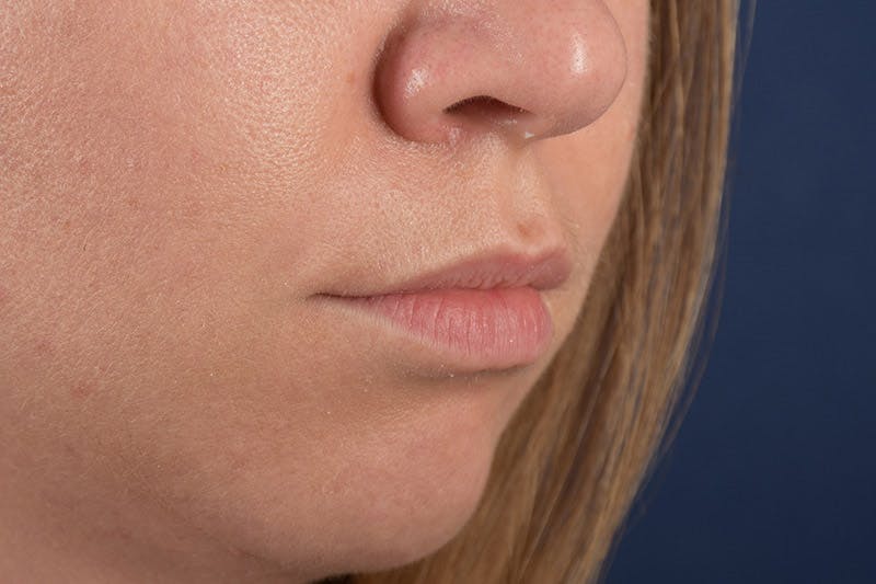 Facial Fillers Before & After Gallery - Patient 9710252 - Image 5