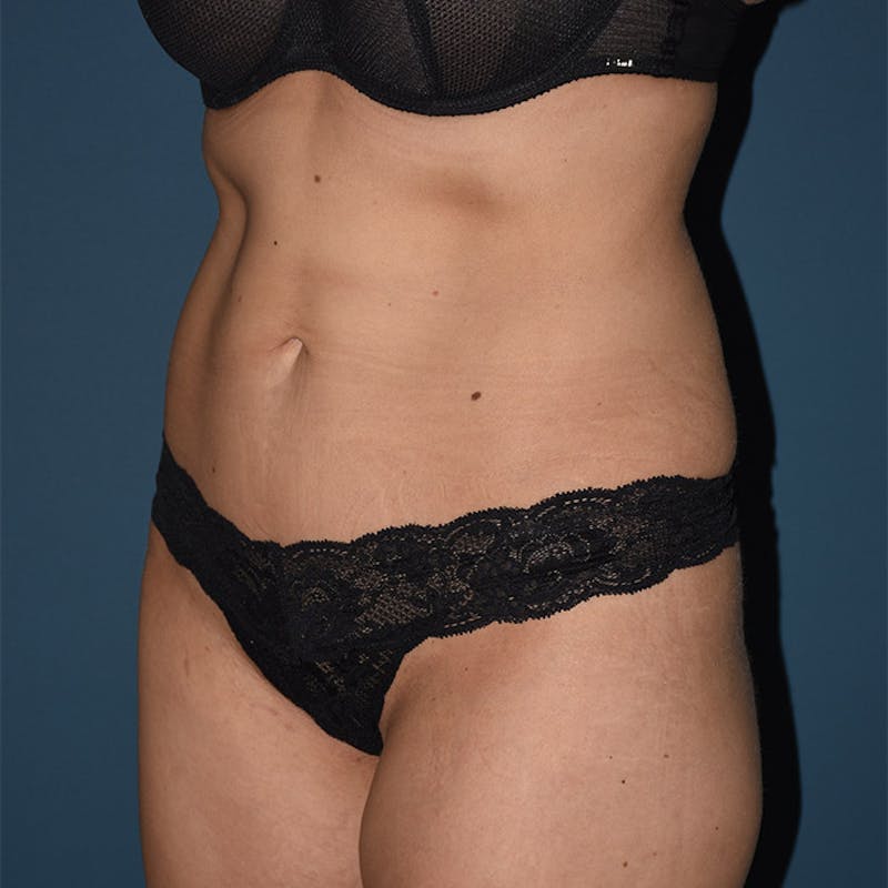 Coolsculpting Before & After Gallery - Patient 9710256 - Image 4