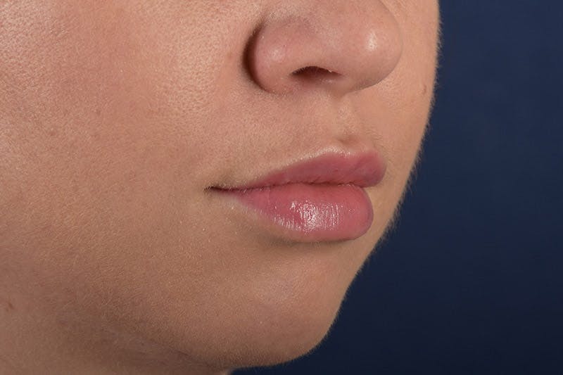 Facial Fillers Before & After Gallery - Patient 9710252 - Image 6