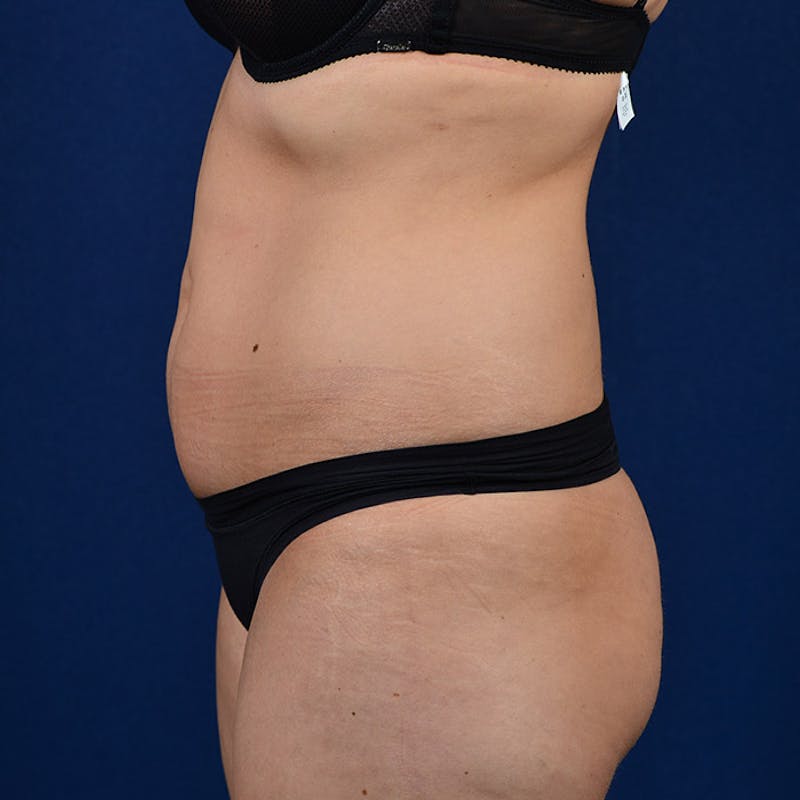 Coolsculpting Before & After Gallery - Patient 9710256 - Image 5