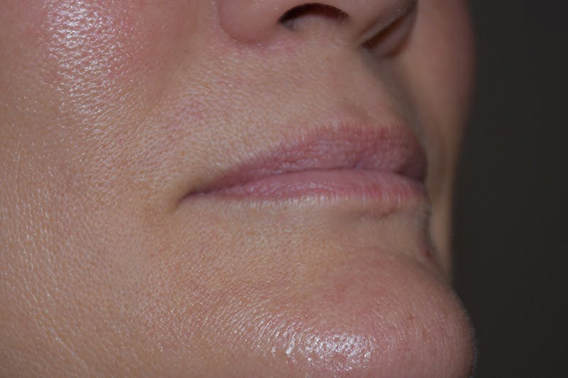 Facial Fillers Before & After Gallery - Patient 9710261 - Image 1
