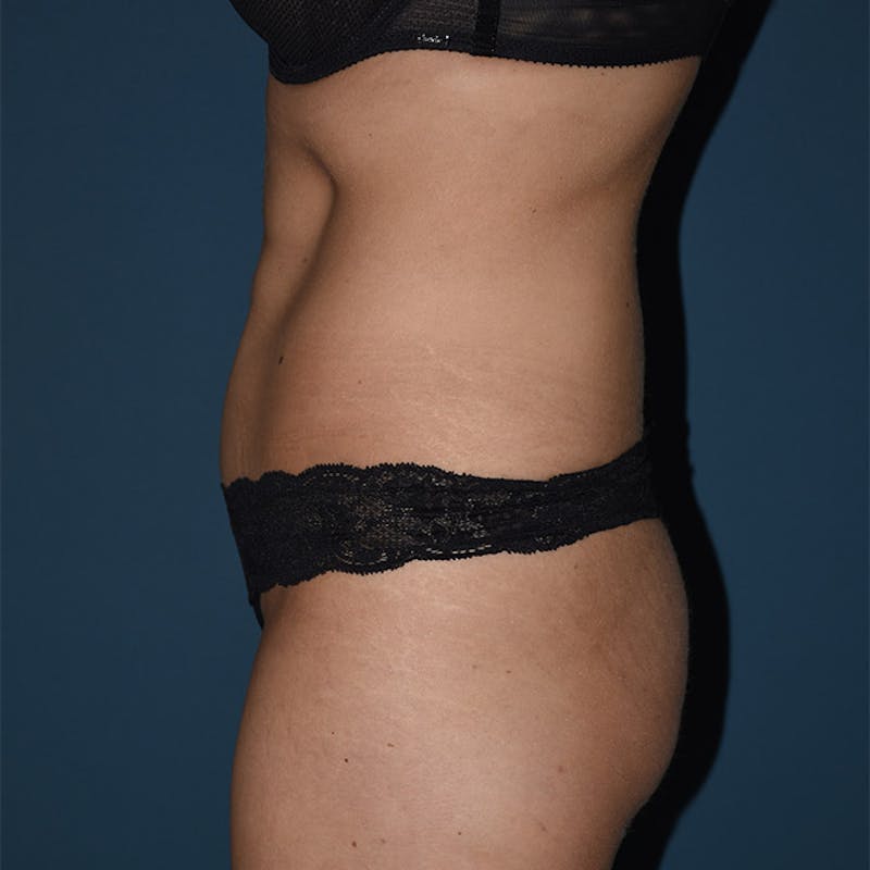 Coolsculpting Before & After Gallery - Patient 9710256 - Image 6
