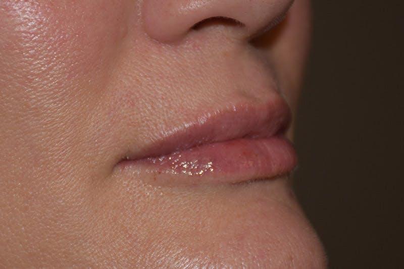 Facial Fillers Before & After Gallery - Patient 9710261 - Image 2