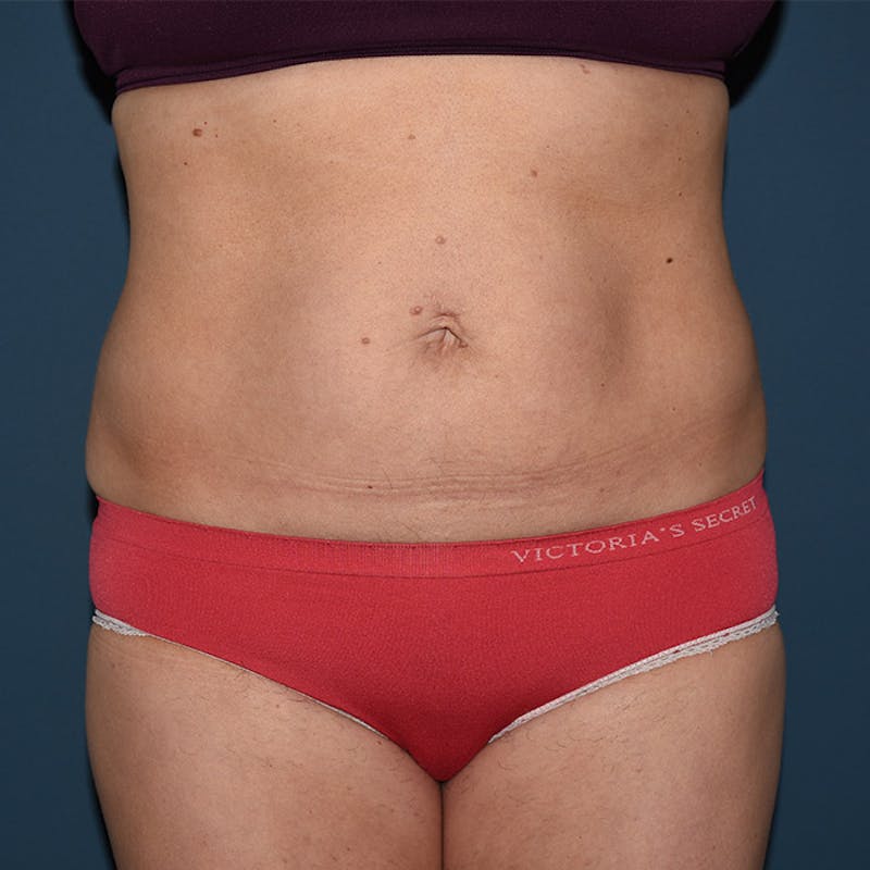 Coolsculpting Before & After Gallery - Patient 9710260 - Image 1