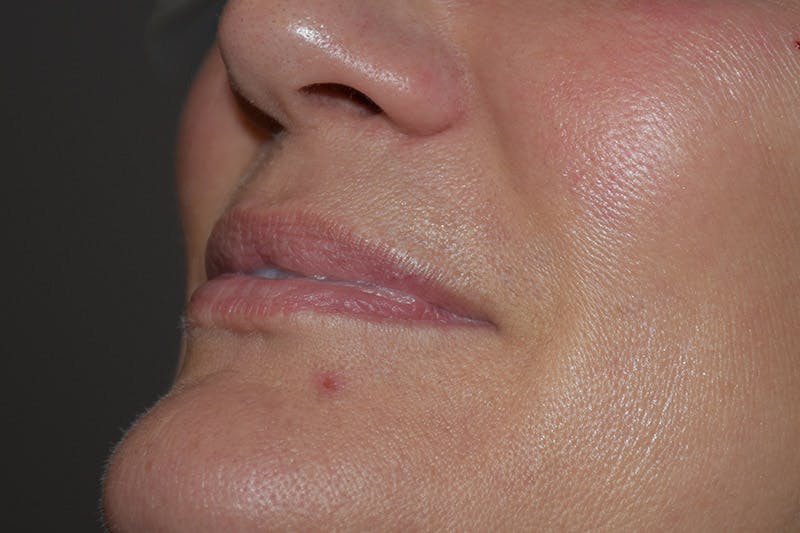 Facial Fillers Before & After Gallery - Patient 9710261 - Image 3