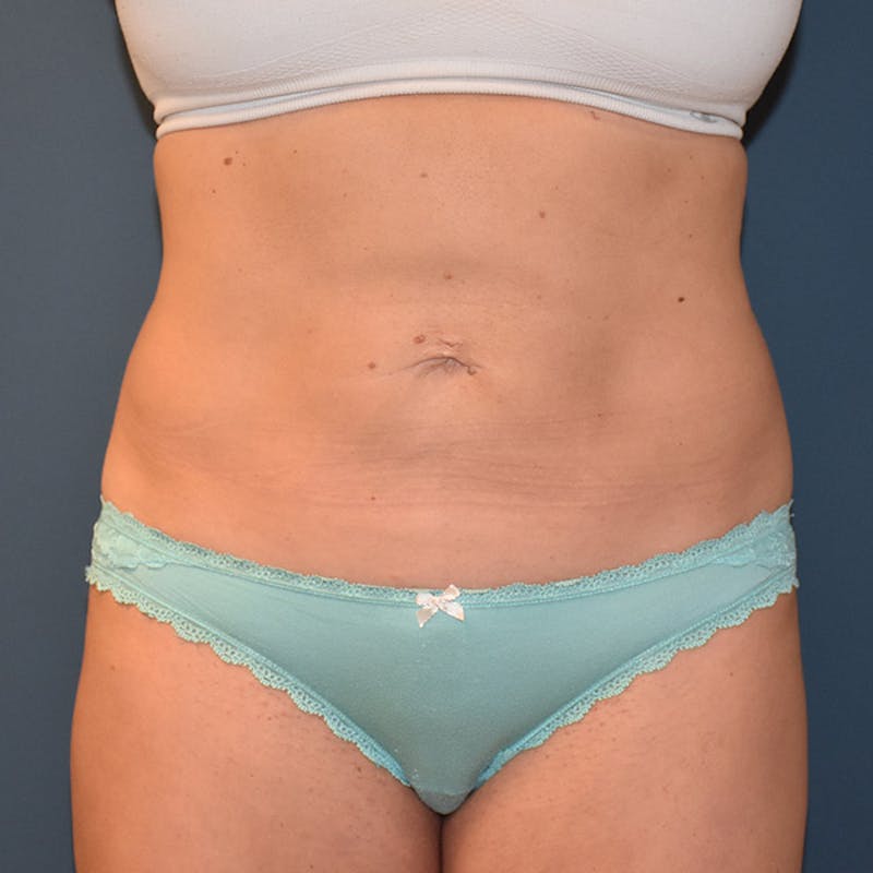 Coolsculpting Gallery - Patient 9710260 - Image 2