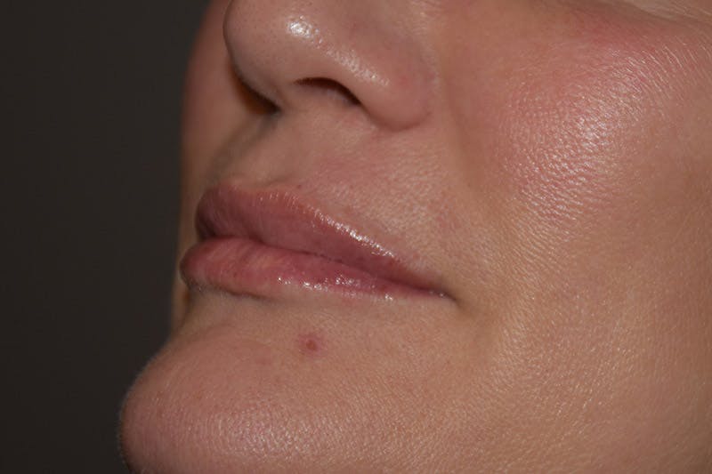 Facial Fillers Gallery - Patient 9710261 - Image 4