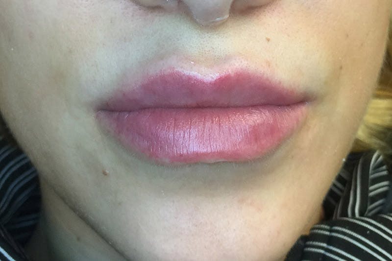 Facial Fillers Before & After Gallery - Patient 9710263 - Image 2