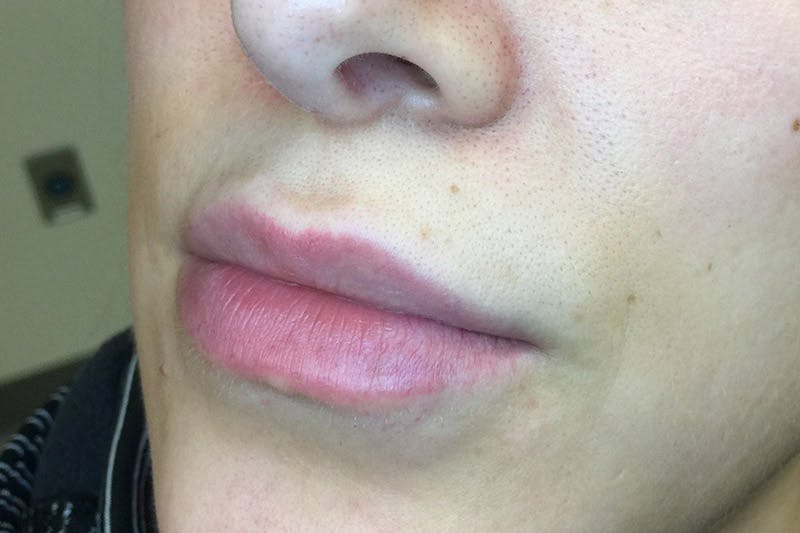 Facial Fillers Before & After Gallery - Patient 9710263 - Image 3