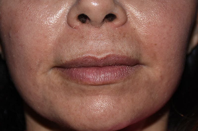 Facial Fillers Before & After Gallery - Patient 9710266 - Image 1