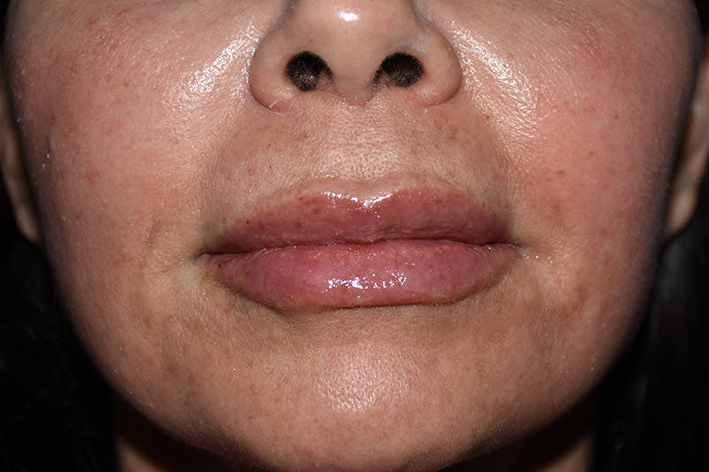 Facial Fillers Before & After Gallery - Patient 9710266 - Image 2