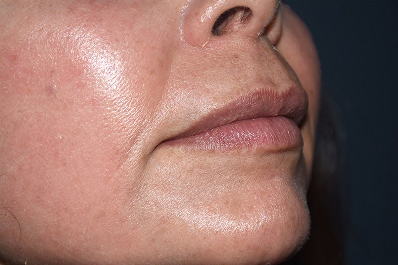 Facial Fillers Before & After Gallery - Patient 9710266 - Image 3