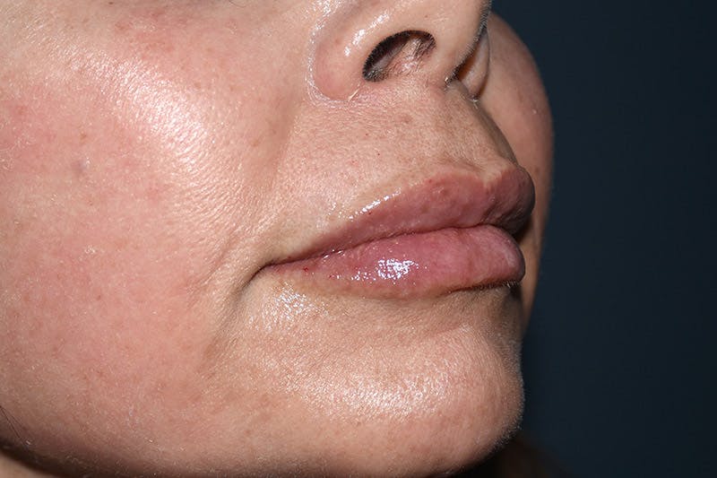 Facial Fillers Before & After Gallery - Patient 9710266 - Image 4