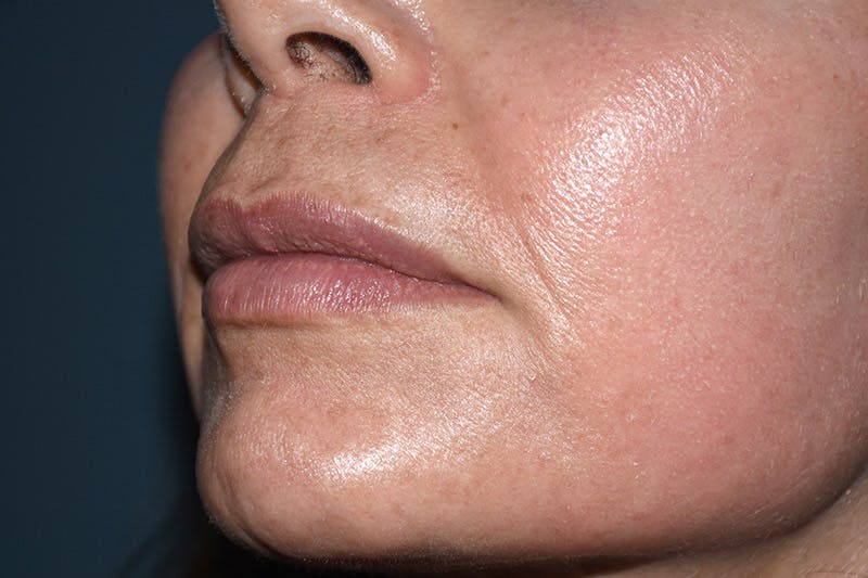 Facial Fillers Before & After Gallery - Patient 9710266 - Image 5