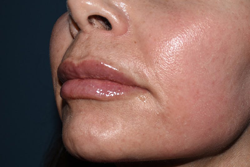 Facial Fillers Before & After Gallery - Patient 9710266 - Image 6