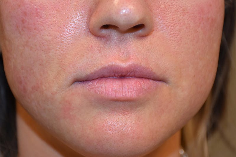 Facial Fillers Before & After Gallery - Patient 9710269 - Image 1