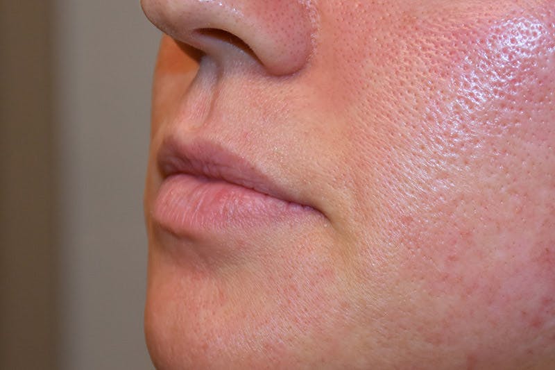 Facial Fillers Before & After Gallery - Patient 9710269 - Image 3