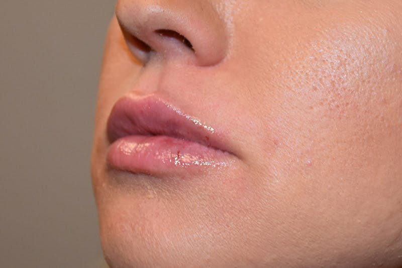 Facial Fillers Before & After Gallery - Patient 9710269 - Image 4