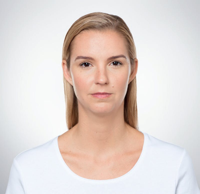 Kybella Before & After Gallery - Patient 9712239 - Image 1