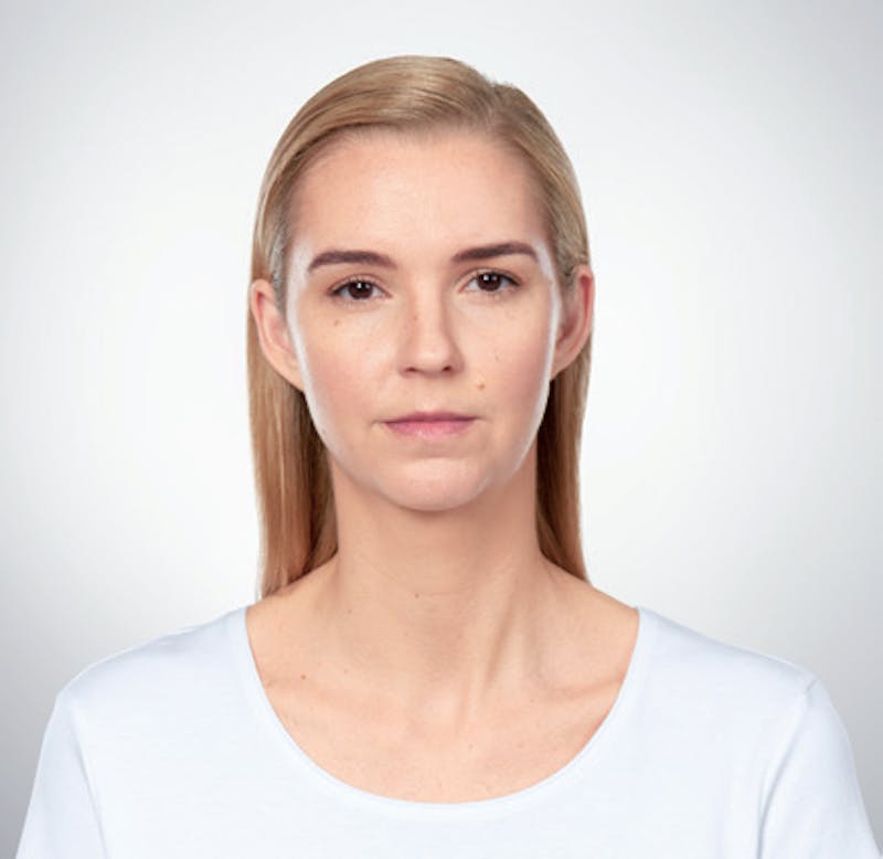 Kybella Before & After Gallery - Patient 9712239 - Image 2