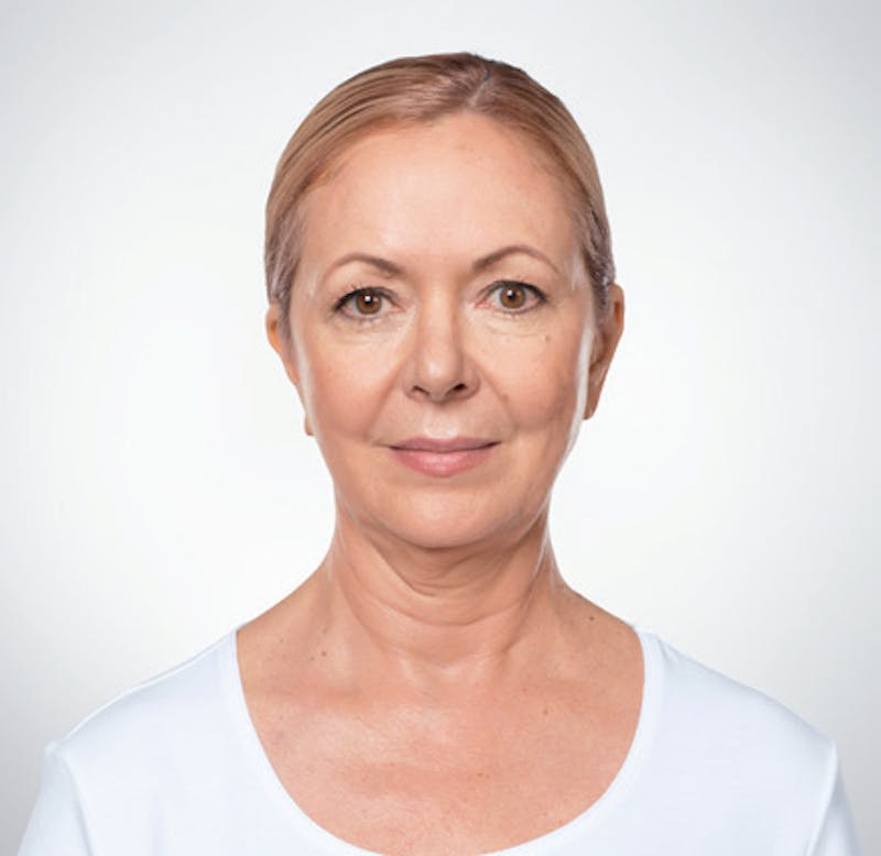Kybella Before & After Gallery - Patient 9712246 - Image 1