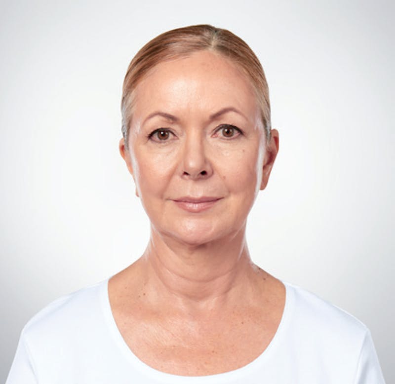 Kybella Before & After Gallery - Patient 9712246 - Image 2