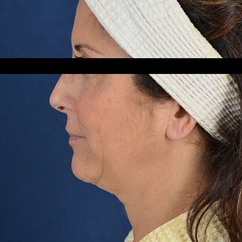 Ultherapy Before & After Gallery - Patient 9712296 - Image 1
