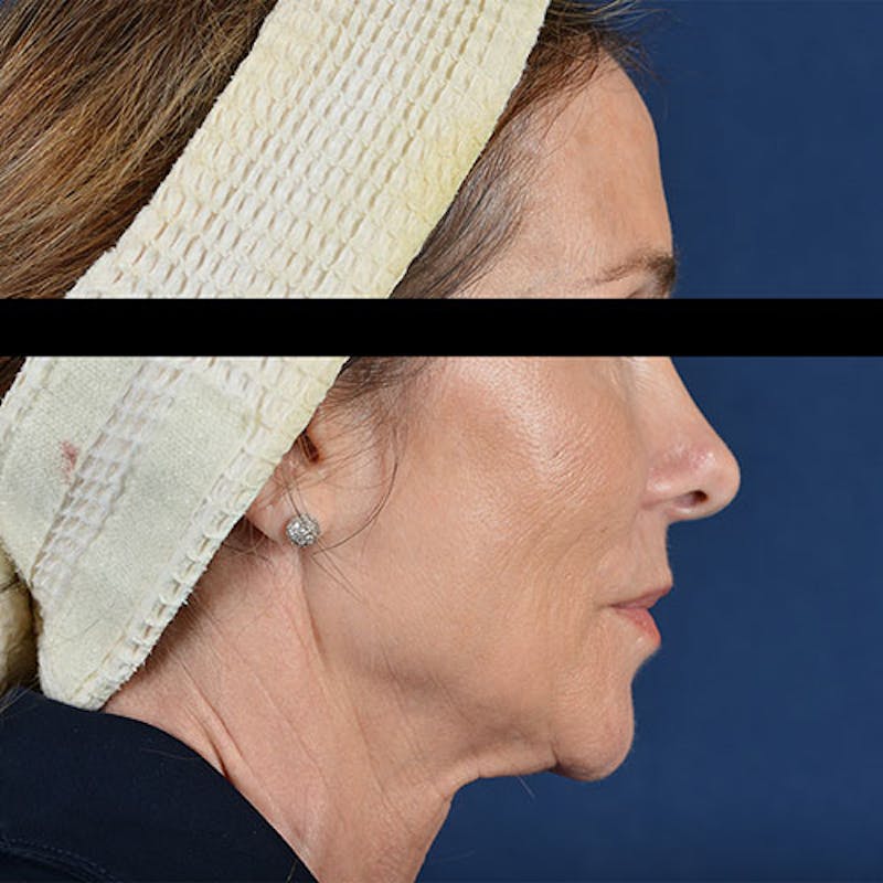 Ultherapy Before & After Gallery - Patient 9712299 - Image 1