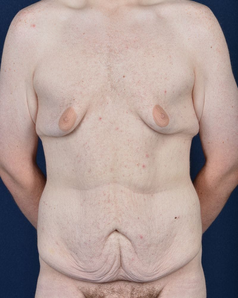 Gynecomastia Before & After Gallery - Patient 9712315 - Image 1