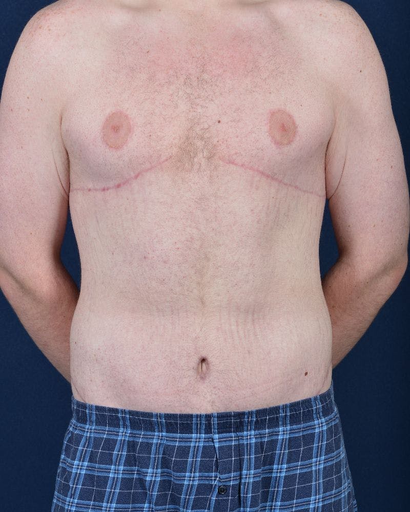 Gynecomastia Before & After Gallery - Patient 9712315 - Image 2
