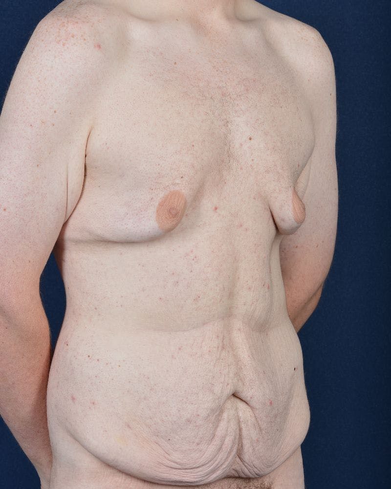 Gynecomastia Before & After Gallery - Patient 9712315 - Image 3