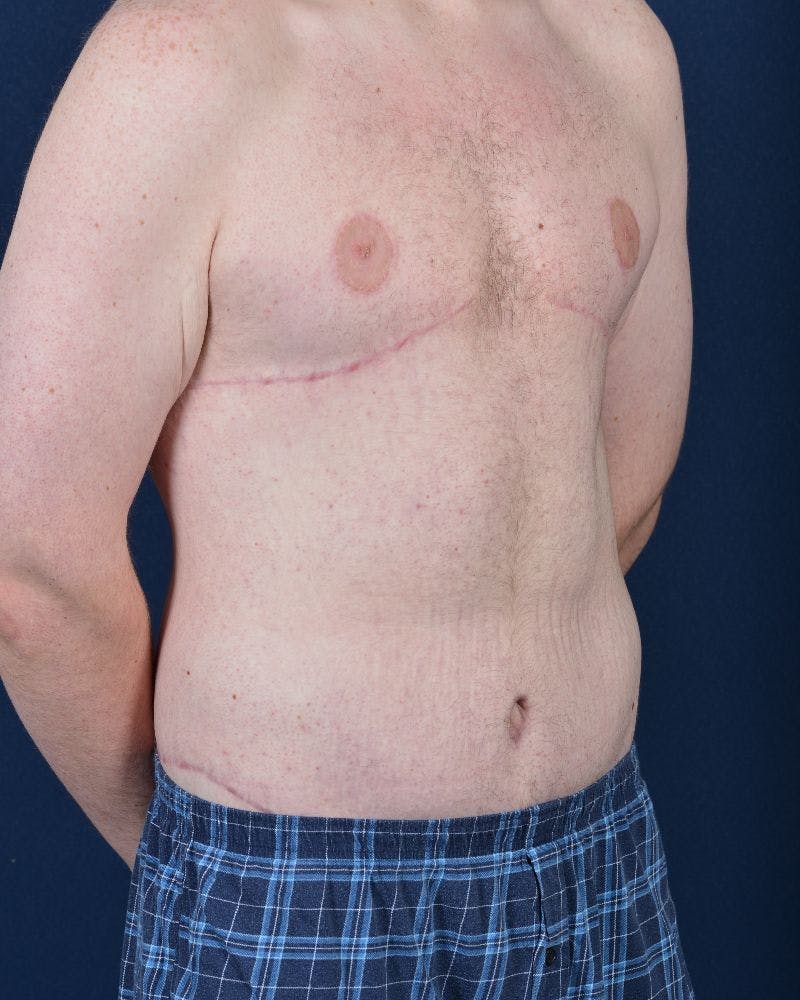 Gynecomastia Before & After Gallery - Patient 9712315 - Image 4