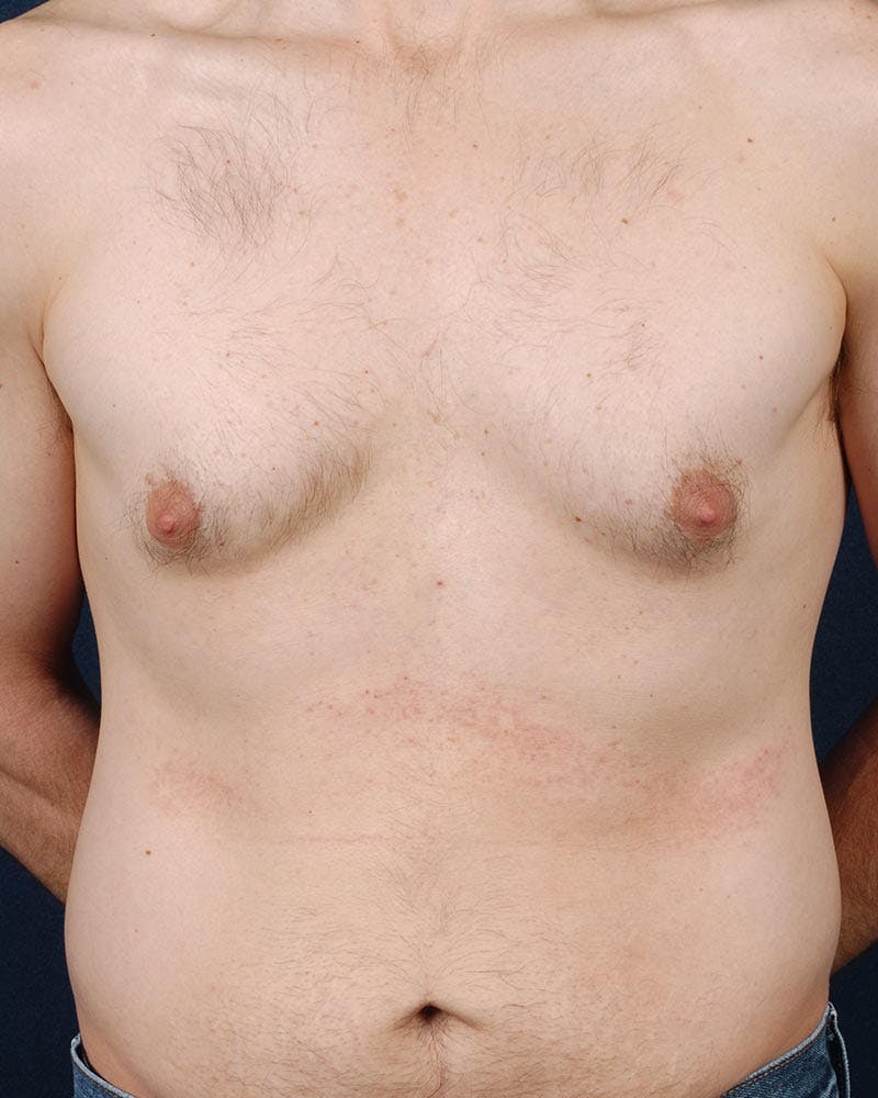 Gynecomastia Before & After Gallery - Patient 9712316 - Image 1