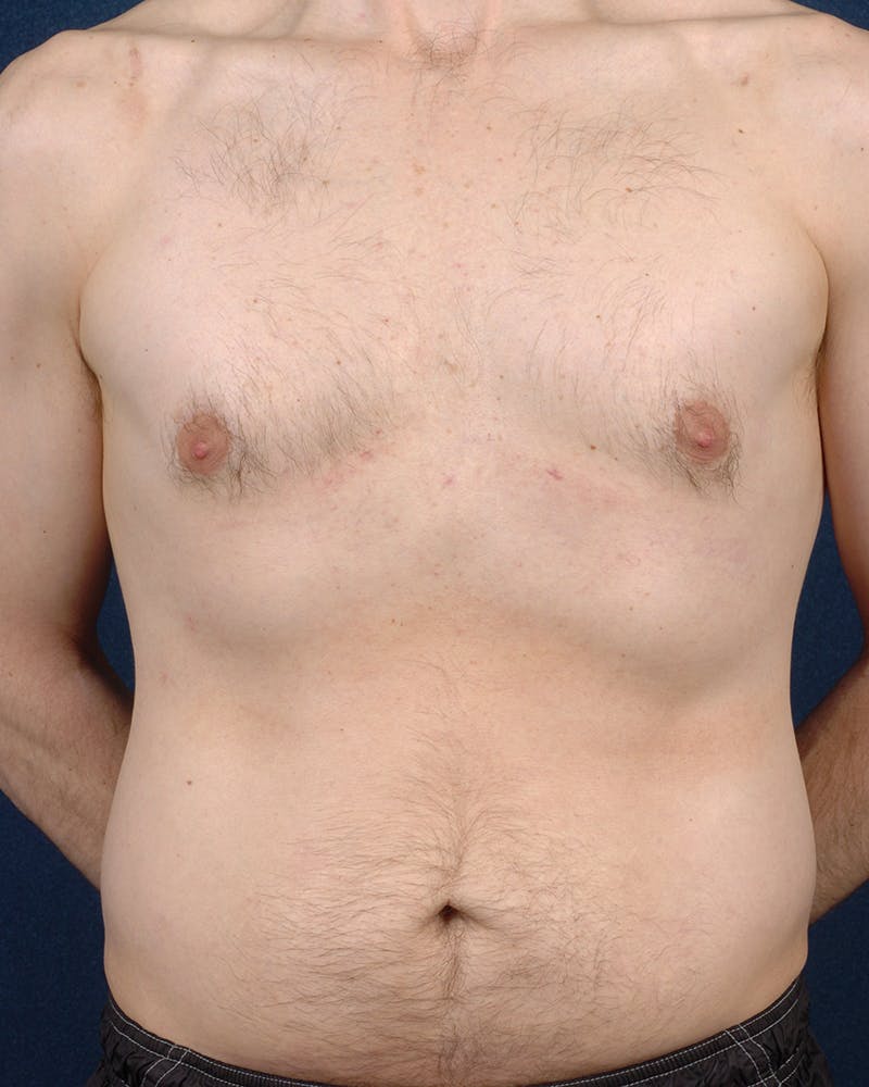Gynecomastia Before & After Gallery - Patient 9712316 - Image 2