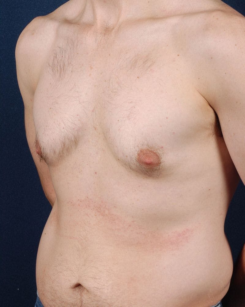 Gynecomastia Before & After Gallery - Patient 9712316 - Image 3