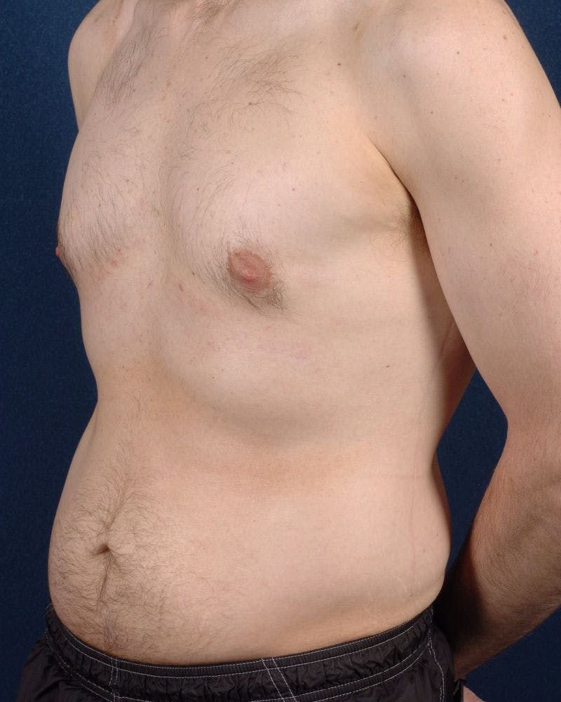 Gynecomastia Before & After Gallery - Patient 9712316 - Image 4