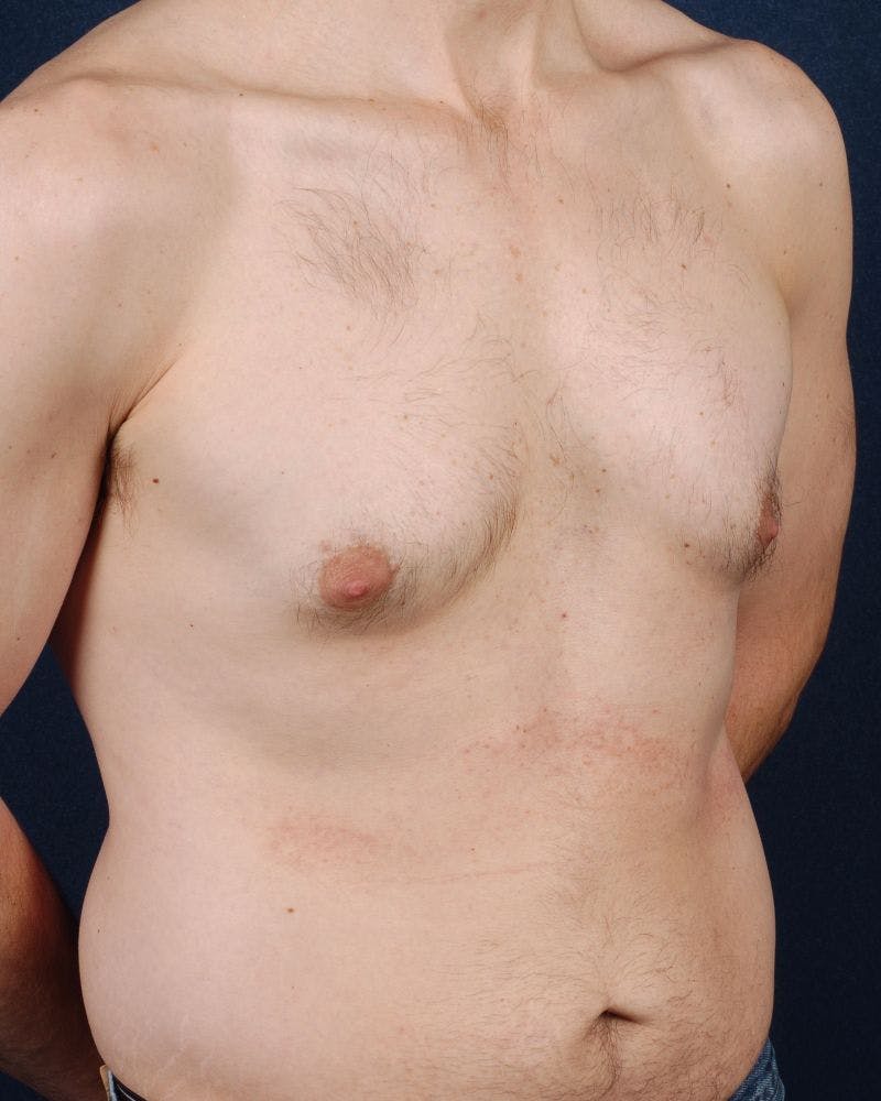 Gynecomastia Before & After Gallery - Patient 9712316 - Image 5