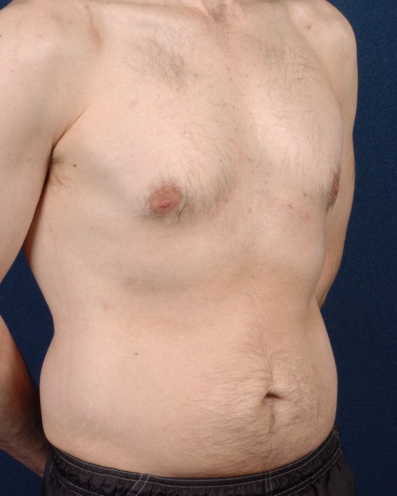 Gynecomastia Before & After Gallery - Patient 9712316 - Image 6