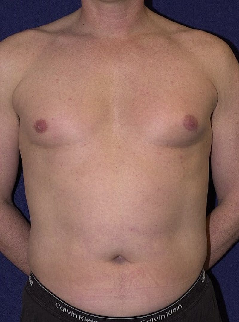 Gynecomastia Before & After Gallery - Patient 9712321 - Image 1
