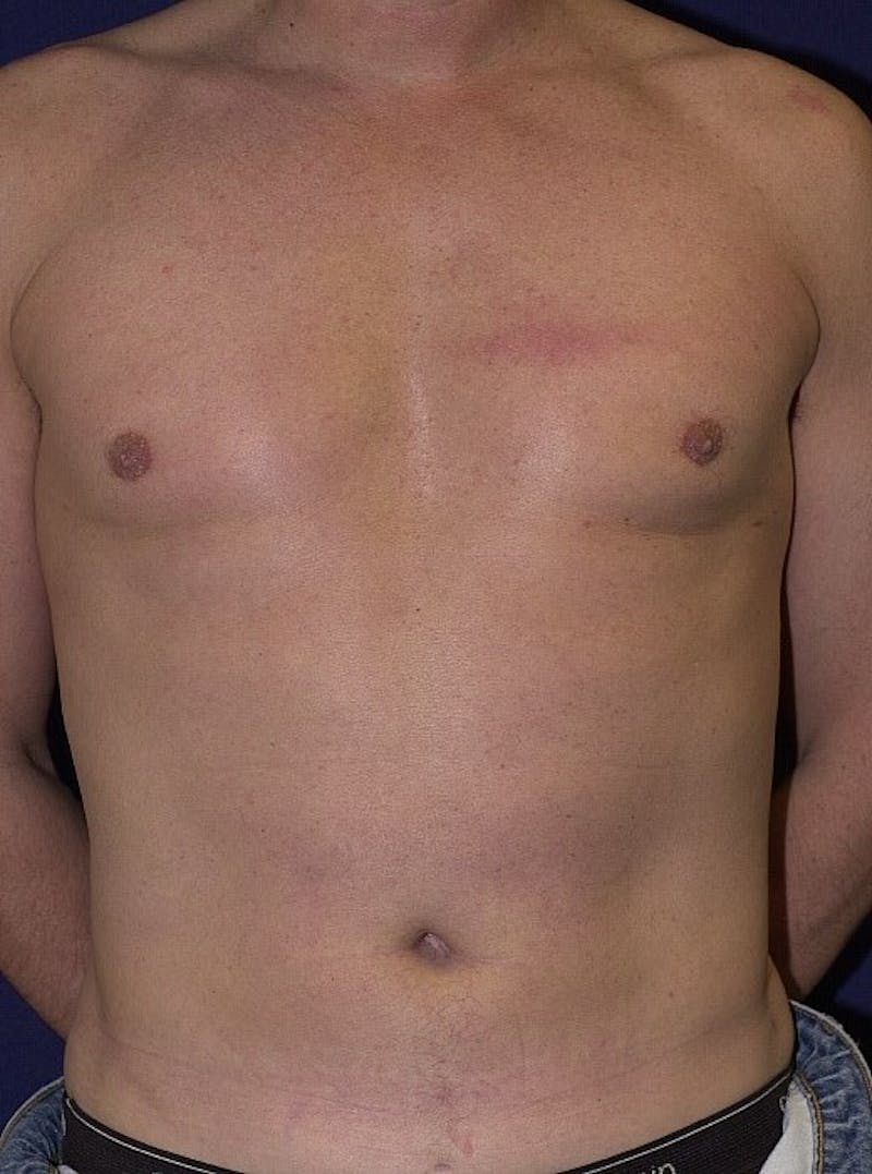 Gynecomastia Before & After Gallery - Patient 9712321 - Image 2