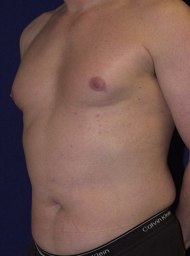 Gynecomastia Before & After Gallery - Patient 9712321 - Image 3