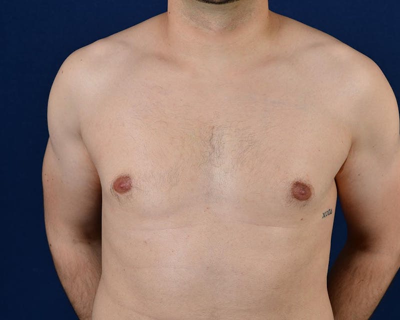Gynecomastia Before & After Gallery - Patient 9712327 - Image 1