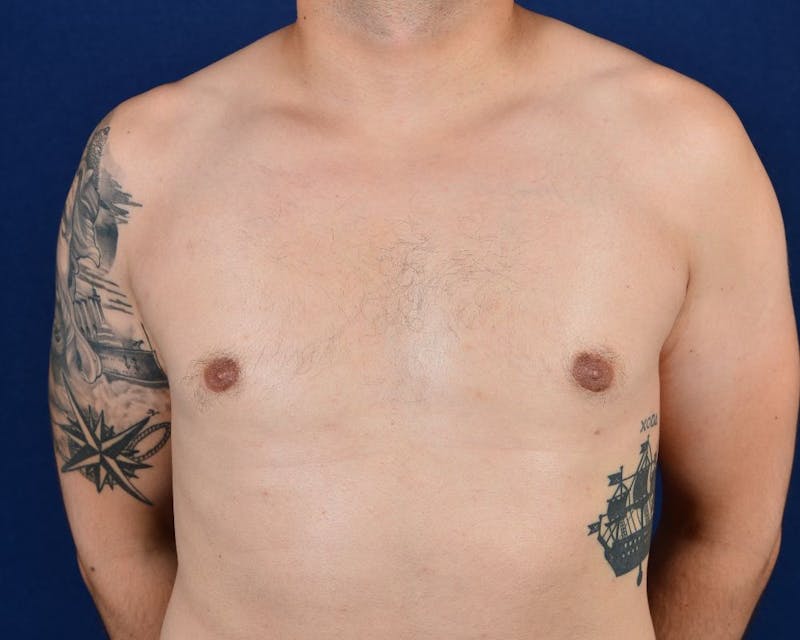Gynecomastia Before & After Gallery - Patient 9712327 - Image 2