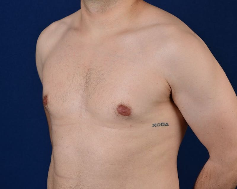 Gynecomastia Before & After Gallery - Patient 9712327 - Image 3