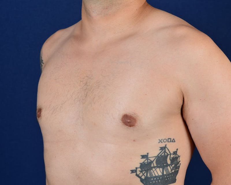 Gynecomastia Before & After Gallery - Patient 9712327 - Image 4