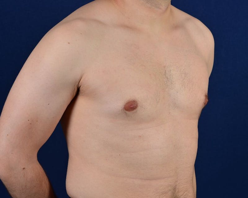 Gynecomastia Before & After Gallery - Patient 9712327 - Image 5