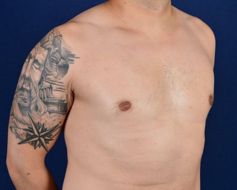 Gynecomastia Before & After Gallery - Patient 9712327 - Image 6