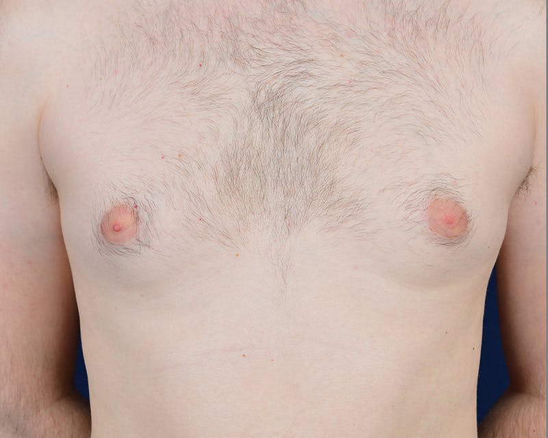 Gynecomastia Before & After Gallery - Patient 9712328 - Image 1