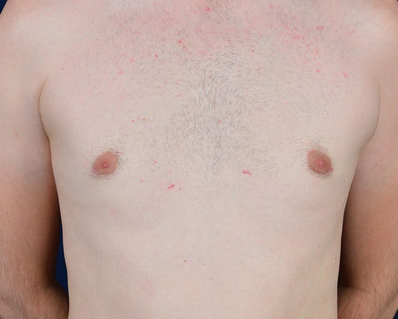 Gynecomastia Before & After Gallery - Patient 9712328 - Image 2