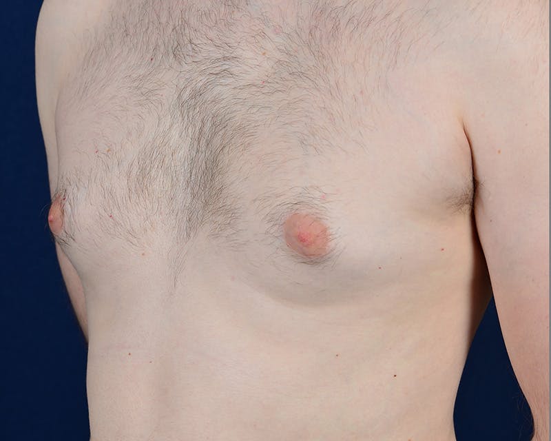 Gynecomastia Before & After Gallery - Patient 9712328 - Image 3